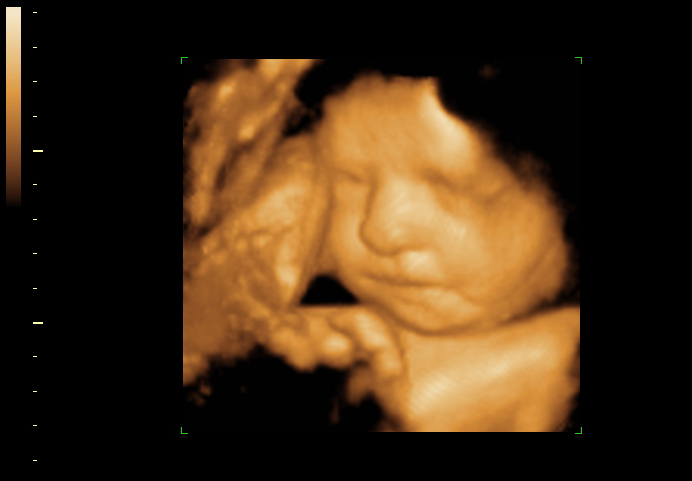 3D ultrasound image at 28 weeks